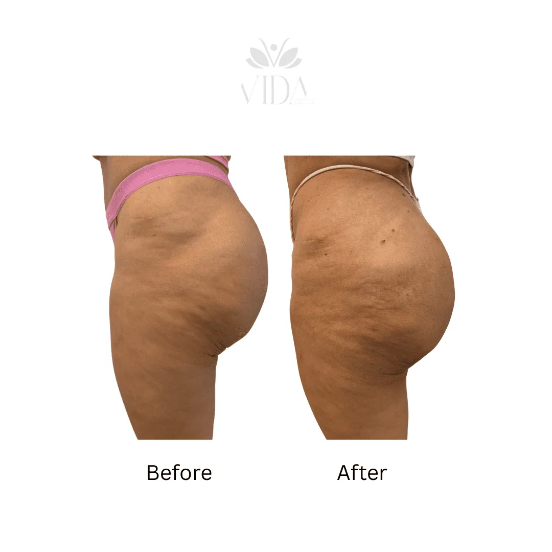 Liquid BBL Treatment Patient Before and After Photos in Houston, TX | Vida Aesthetics And Wellness