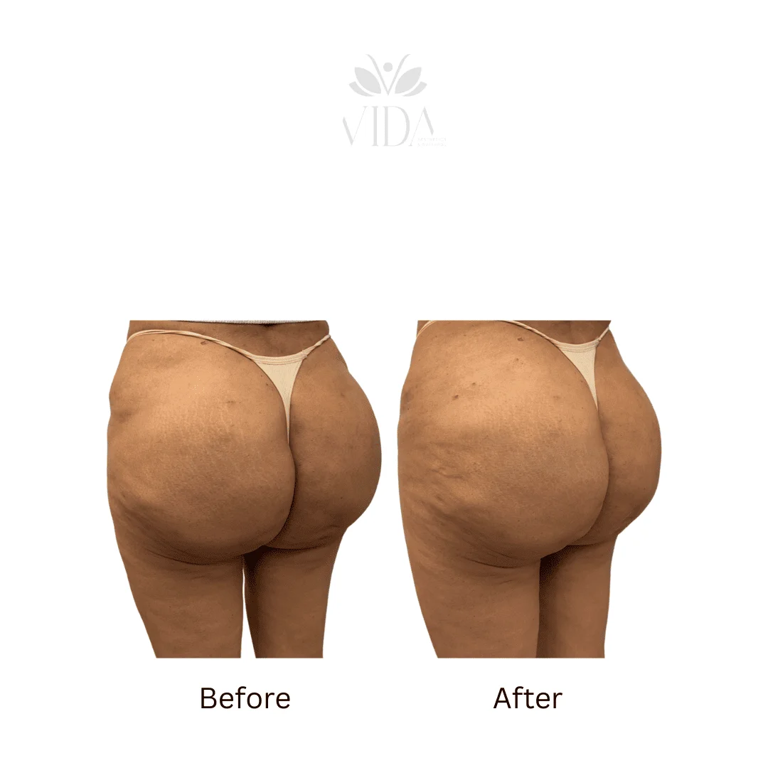 Liquid BBL Treatment Patient Before and After Photos in Houston, TX | Vida Aesthetics And Wellness