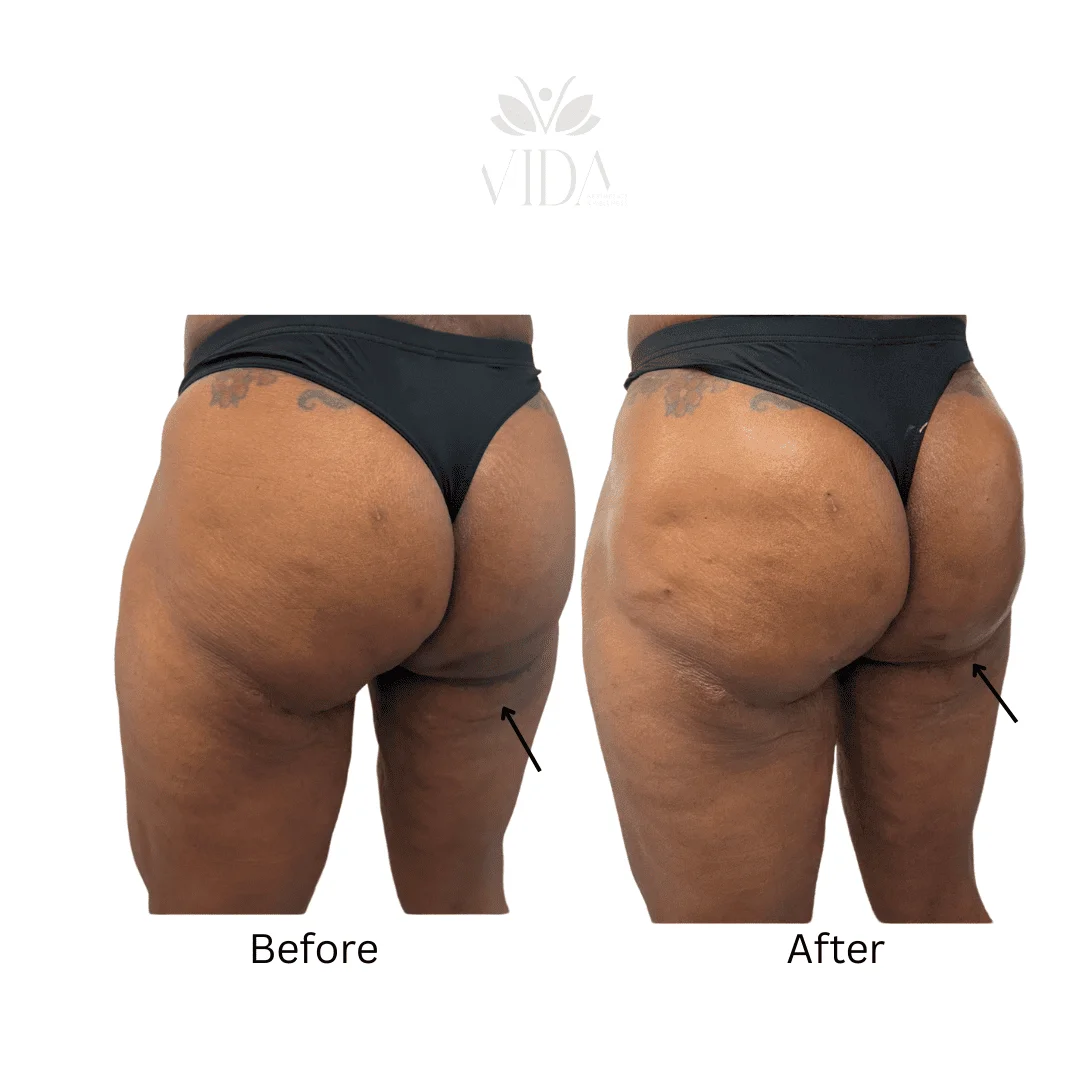 Liquid BBL Treatment Patient Before and After Photos in Houston, TX | Vida Aesthetics And Wellness