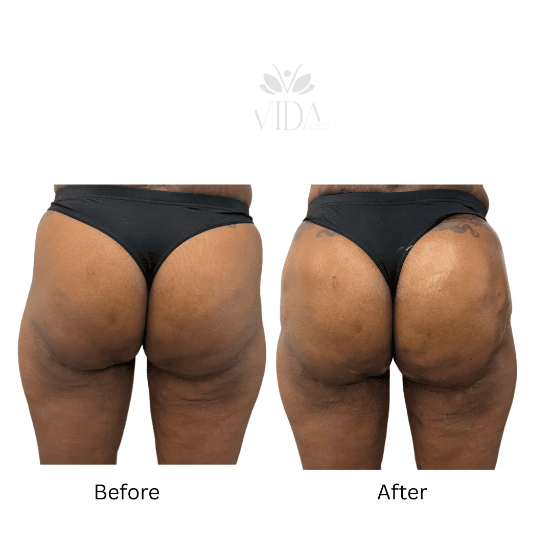 Liquid BBL Treatment Patient Before and After Photos in Houston, TX | Vida Aesthetics And Wellness