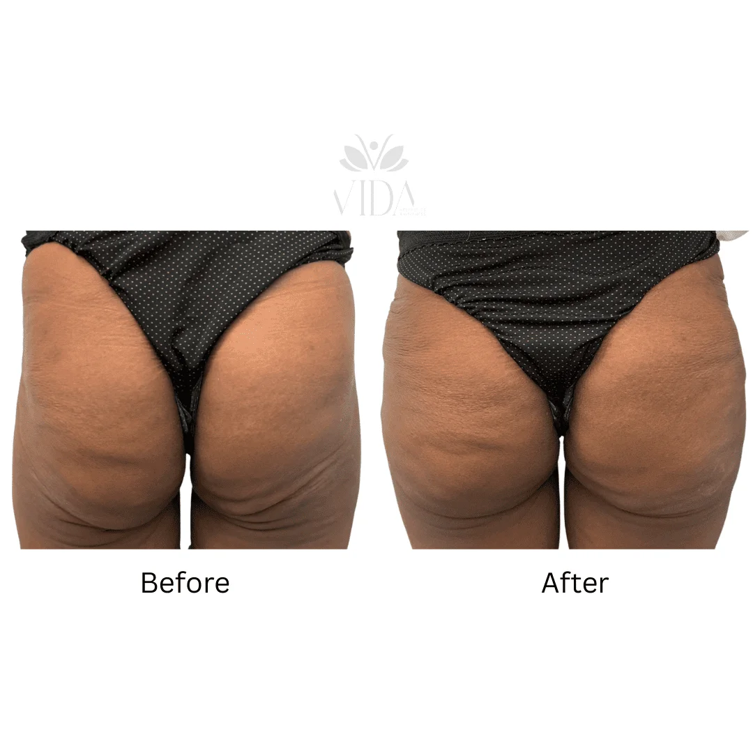 Liquid BBL Treatment Patient Before and After Photos in Houston, TX | Vida Aesthetics And Wellness