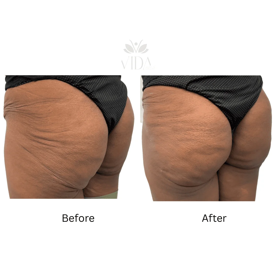 Liquid BBL Treatment Patient Before and After Photos in Houston, TX | Vida Aesthetics And Wellness
