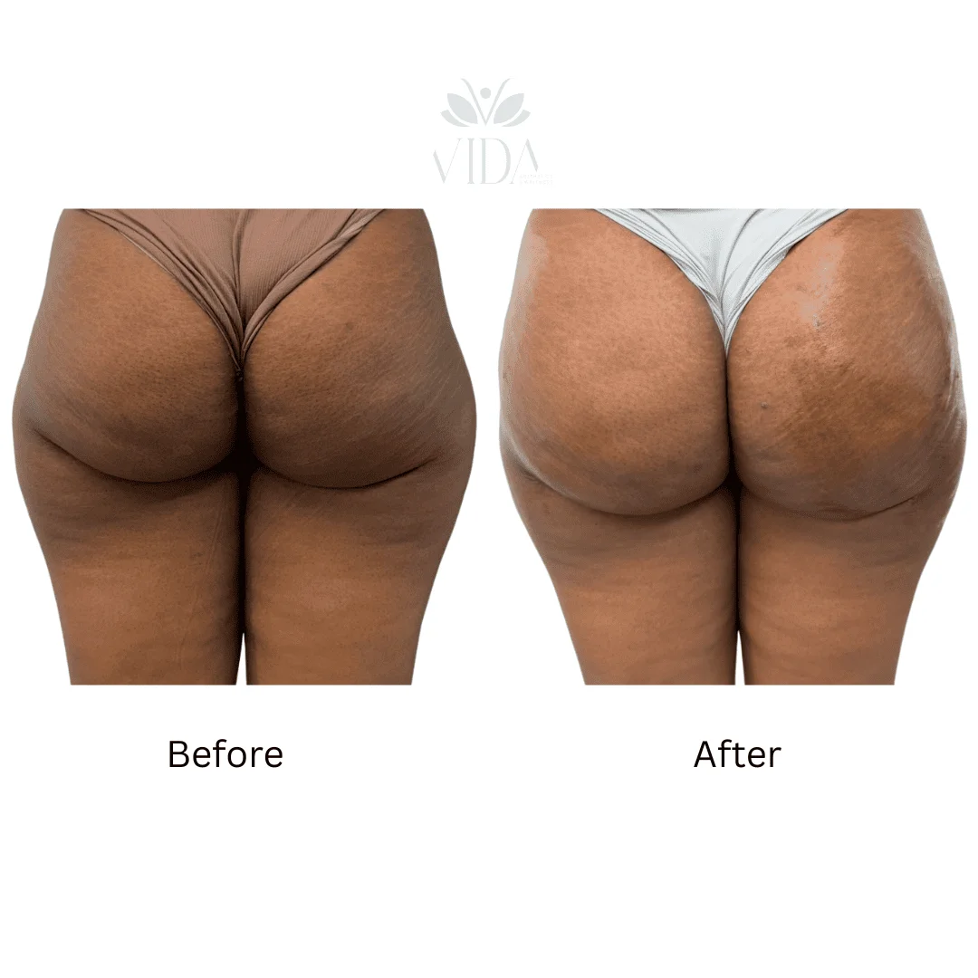 Liquid BBL Treatment Patient Before and After Photos in Houston, TX | Vida Aesthetics And Wellness