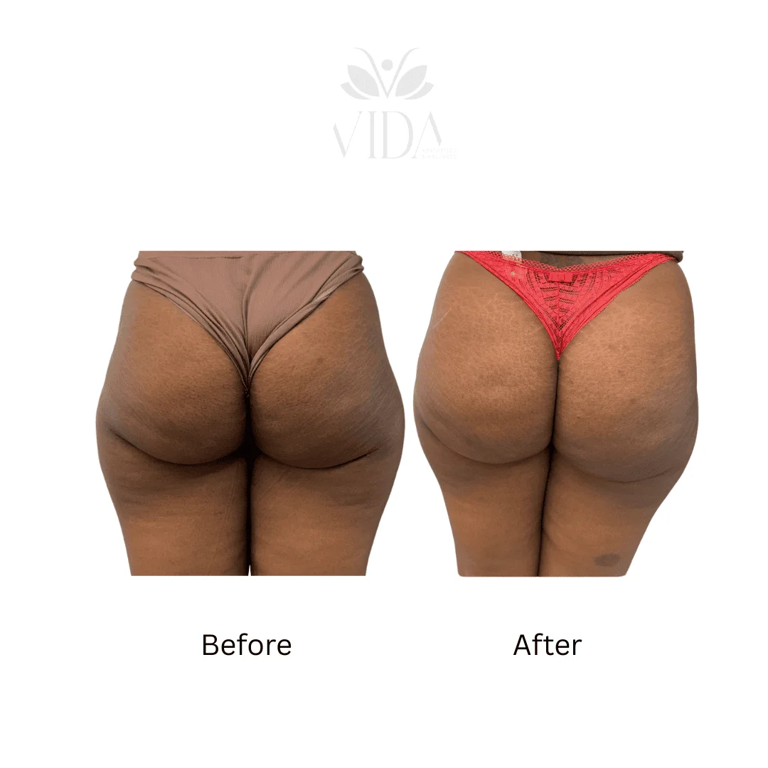 Liquid BBL Treatment Patient Before and After Photos in Houston, TX | Vida Aesthetics And Wellness