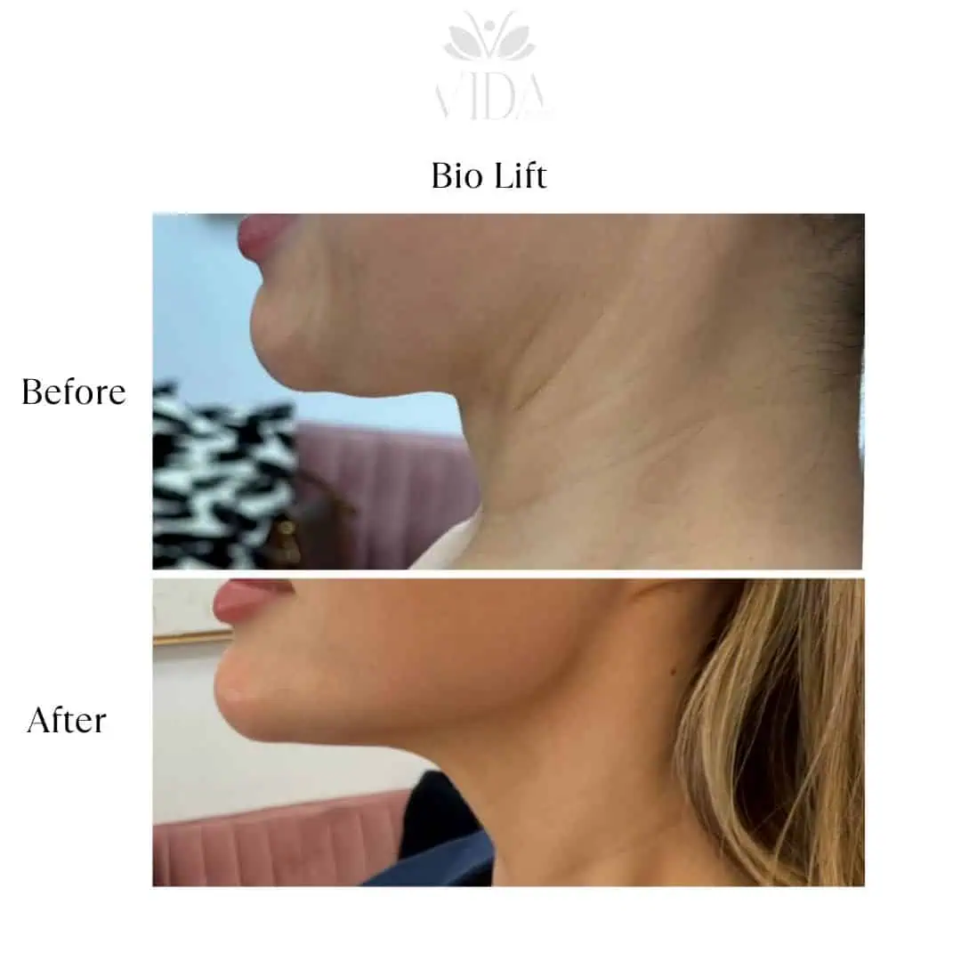 Bio Lift before and after picturess | Vida Aesthetics