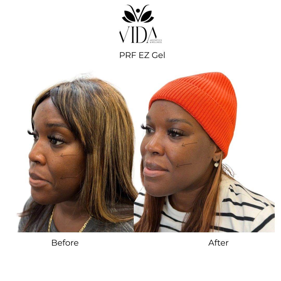 PRF EZ gel before and after