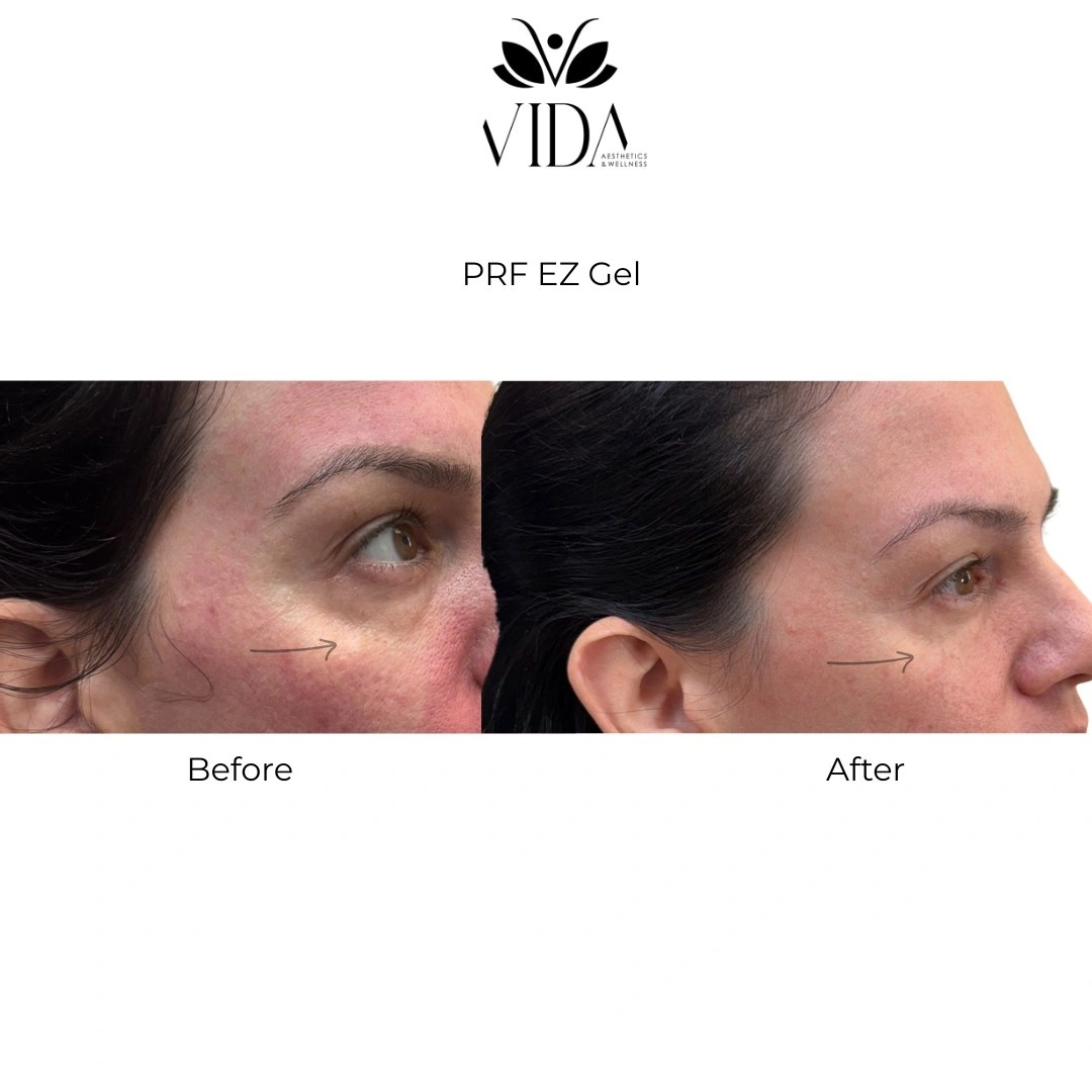 PRF EZ gel before and after