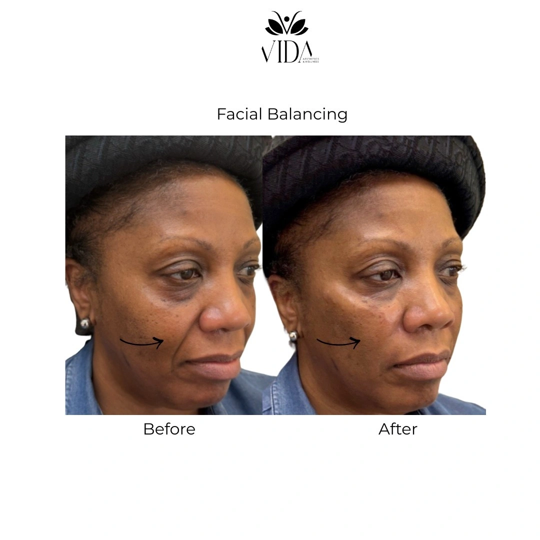 Facial Balancing