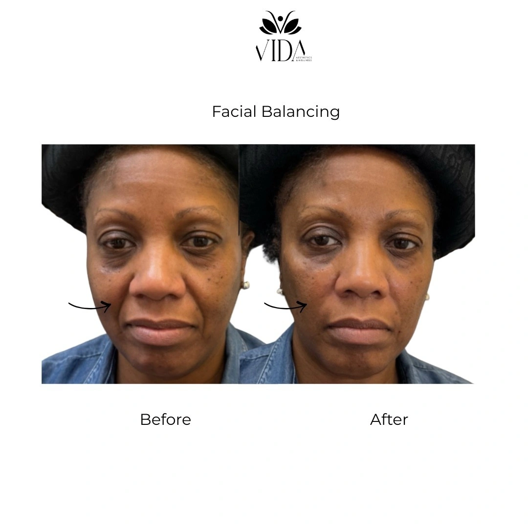 Facial Balancing Filler Before and After