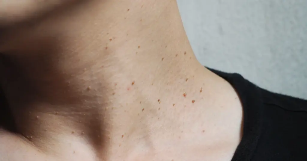 skin tag removal in houston tx