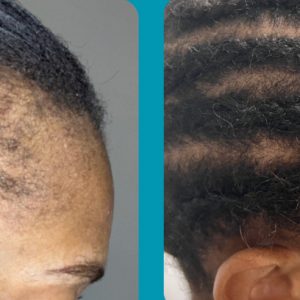 Hair Restoration Before and After Image | Rachel Brown NP in Houston, TX