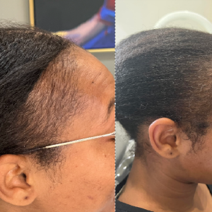 Hair Restoration Before and After Image | Rachel Brown NP in Houston, TX