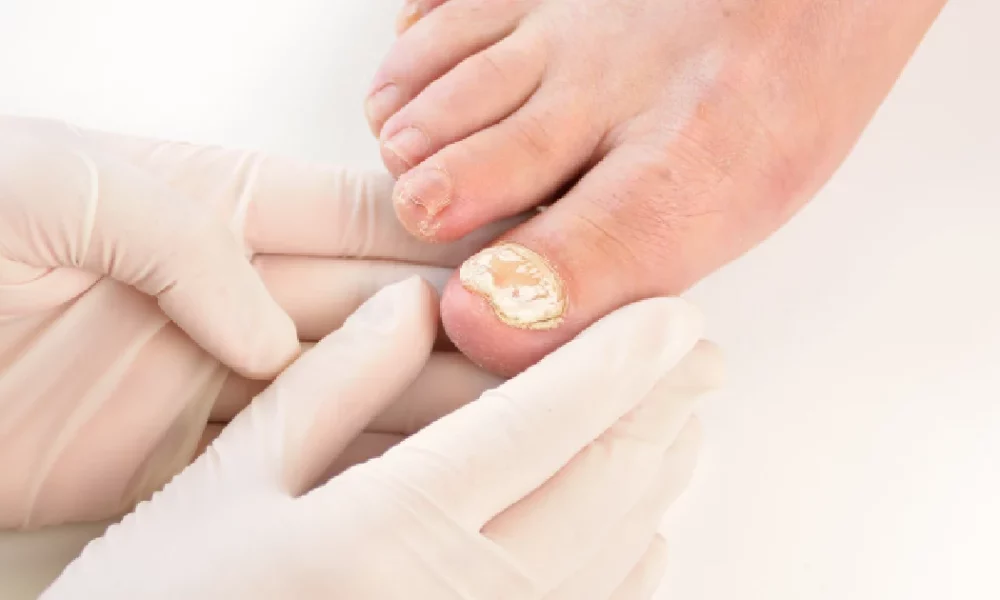 toenail infected with fungus, preparing for treatment with Aerolase Neo Elite laser therapy in Houston, tx