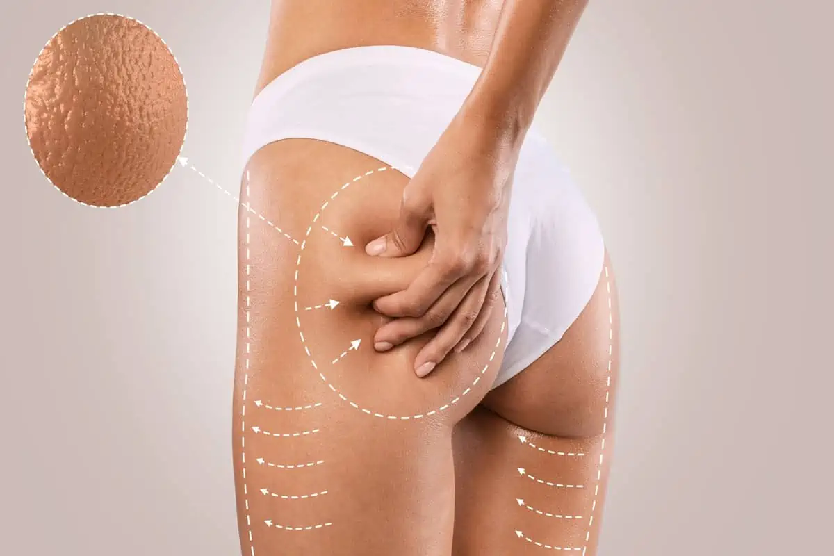 Radiesse Butt Lift by Vida Aesthetics & Wellness in Houston TX